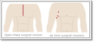 Smaller incisions with minimally invasive heart surgery